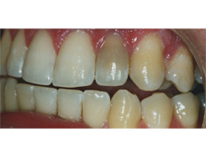 Teeth bleaching